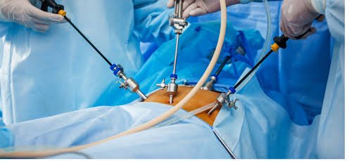 Open Surgery Vs Robotic and Laparascopic surgery